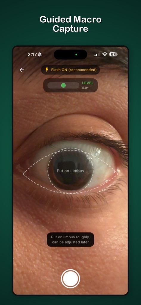 Guided Macro Capture with level indicator and limbus overlay